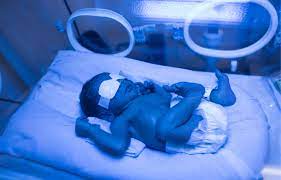 new born has jaundice